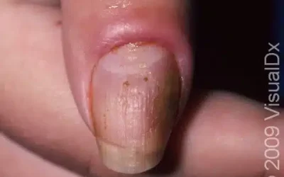 Listen to Your Nails: When to Seek Help